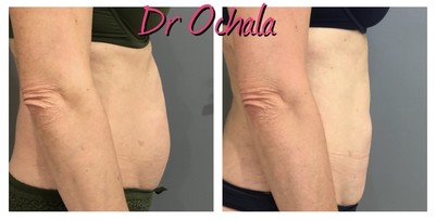 lipoaspiration