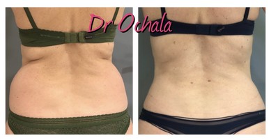 lipoaspiration