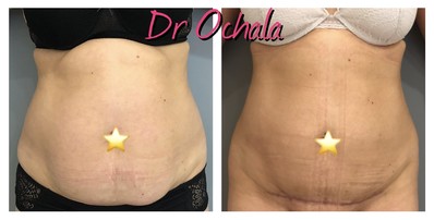 abdominoplastie